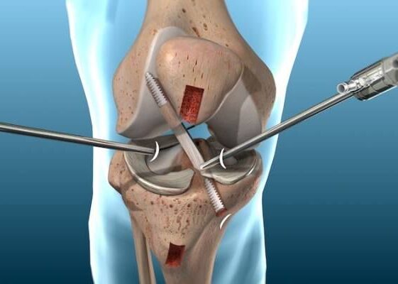 Knee Arthroscopy