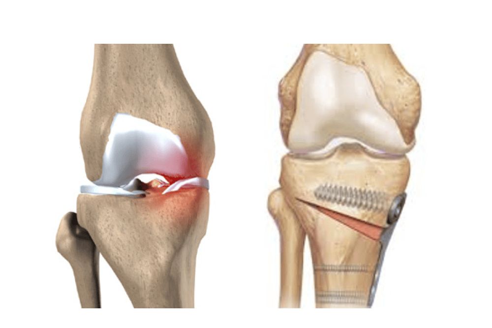 High Tibial Osteotomy